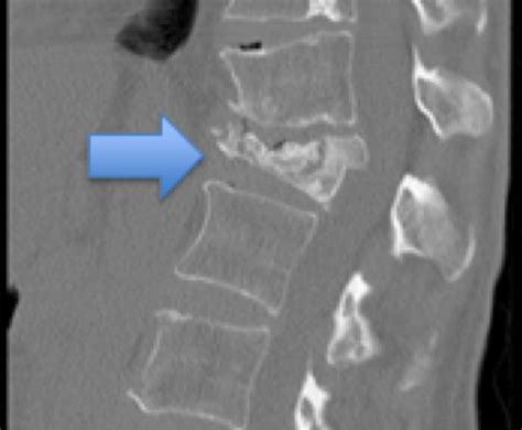 Icd 9 Code For Vertebral Compression Fracture