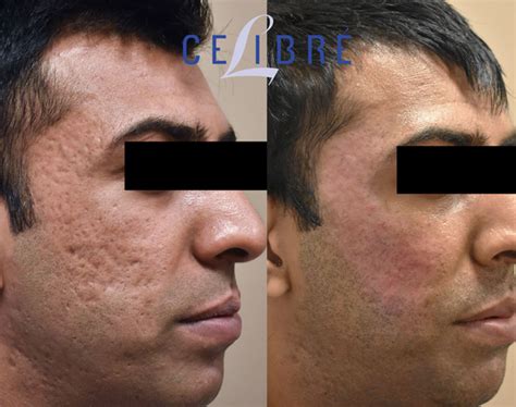 Acne Scar Removal Before and After Pictures of Actual Patients