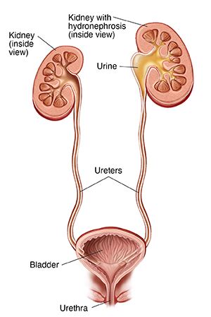 Hydronephrosis: Causes, Symptoms, Diagnosis Treatment, 44% OFF