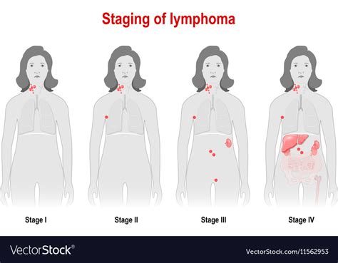 Staging of lymphoma Royalty Free Vector Image - VectorStock