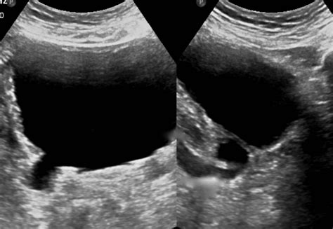 Hutch diverticulum - A rare presentation in an adult | Eurorad