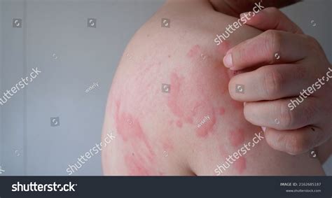 3,198 Allergy Hives Skin Images, Stock Photos & Vectors | Shutterstock