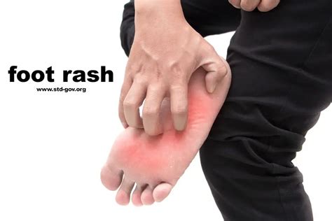 Foot rash | causes, symptoms, home remedies & treatment, pictures