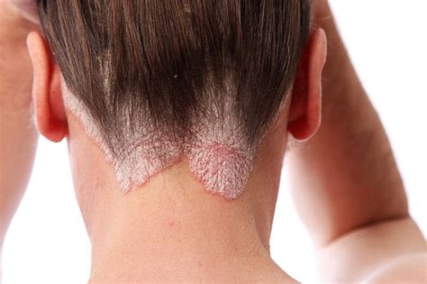 Tinea Capitis - Dermatology Sydney