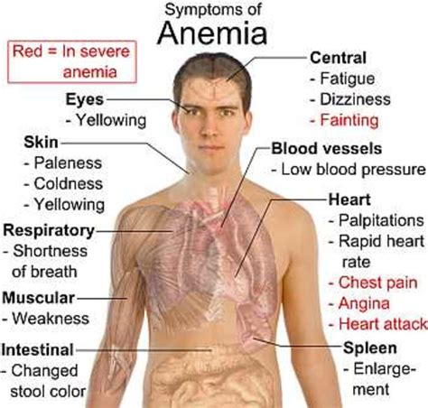 What Is Anemia : Causes, Symptoms, Foods to Cure Iron Deficiency | HubPages