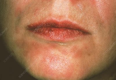 Secondary syphilis rash - Stock Image - M862/0055 - Science Photo Library