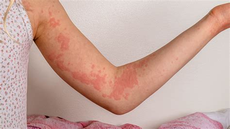 Hives in Children: Urticaria Symptoms and Treatment (for Parents) - GoodRx