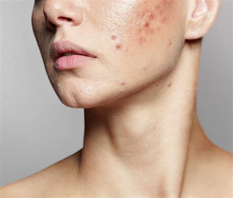 Acne Skin Problems: 4 types of acne and How they form