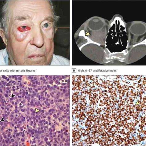 Staging of 57 Primary Ocular Adnexal Diffuse Large B-cell Lymphomas ...