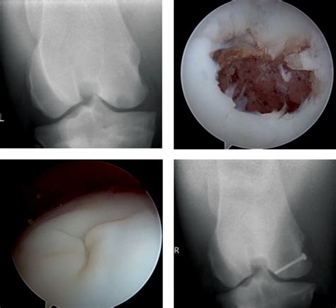 Subchondral Bone Cyst – North Texas Farm and Ranch