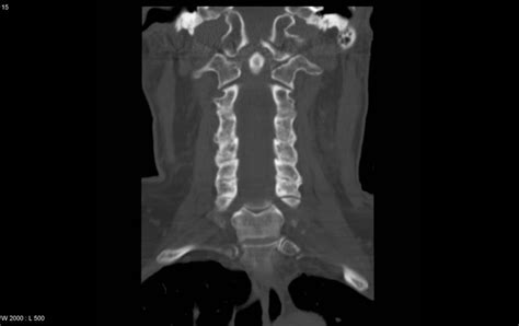 Occipital Condyle Fracture - radRounds Radiology Network