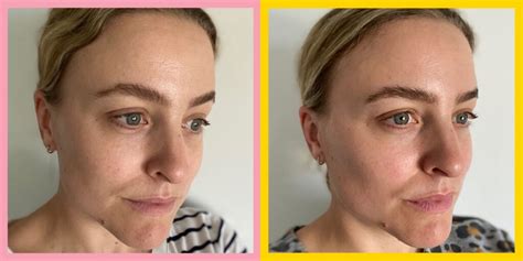 Profhilo Before and After Photos Australia | Bio Remodelling Filler