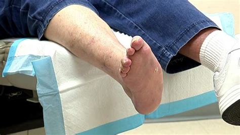 SA doctors leading way in fix for Charcot foot syndrome