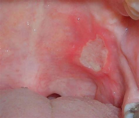 Crohn's mouth ulcers: Symptoms, causes, and treatments