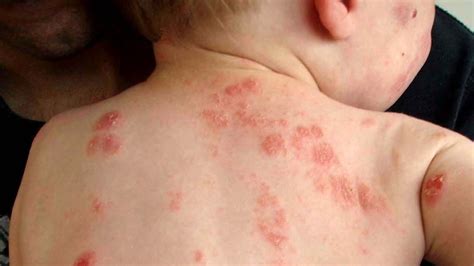 Scientists scratch an itch and make a breakthrough in eczema research ...