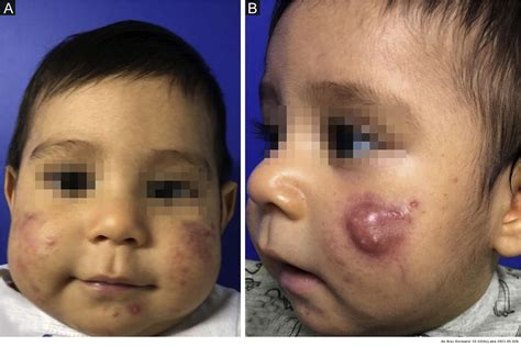 Papulopustular infantile acne treated with oral isotretinoin | Anais ...