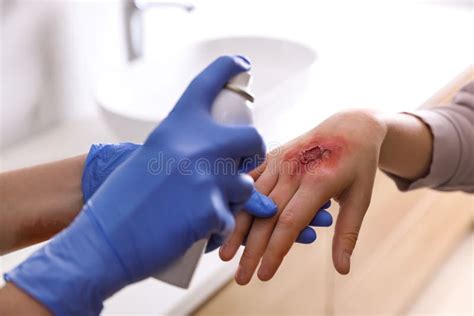 Applying Burn Spray Onto Injured Skin, Closeup Stock Photo - Image of ...