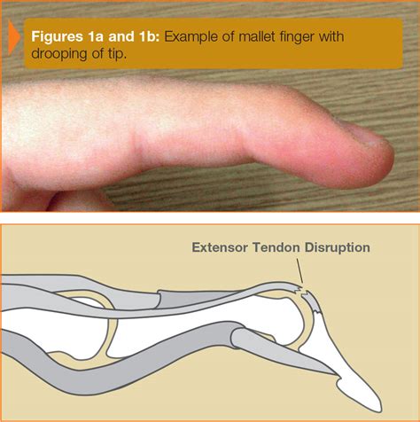 Mallet Injury | Ocean Orthopedic Associates