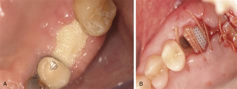 Bone Grafting Complications | Pocket Dentistry