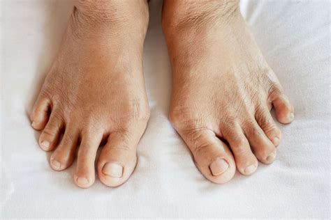 Early Signs of Arthritis in Feet