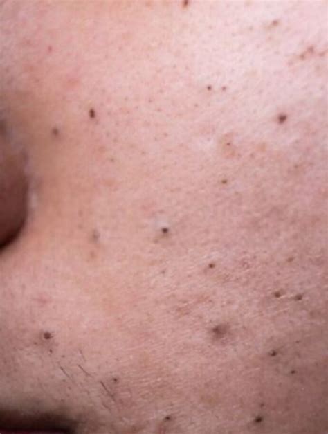 Treating Big Blackheads On Cheeks - Causes, And Prevention Tips ...