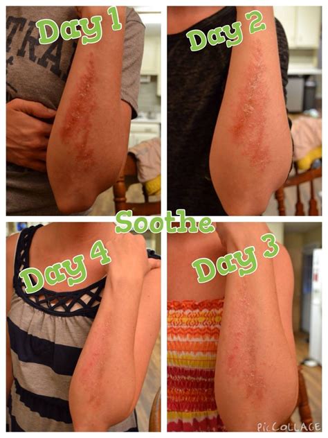 I used Soothe to help with a really bad case of poison ivy! It was at ...