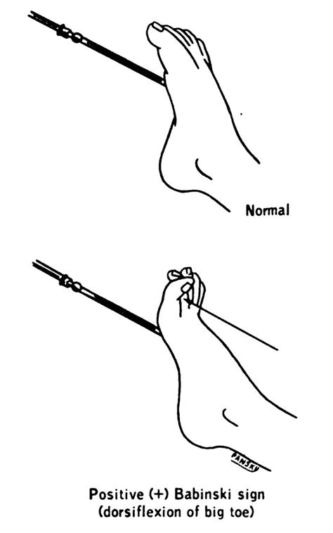 Plantar reflex - Wikipedia | Plantar reflex, Plantar fasciitis, Medical ...