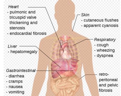 Paraneoplastic Syndrome - Physiopedia