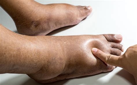 Why Are My Feet Swollen – Causes, Treatments, and Prevention - Massage ...