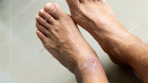 What Are Diabetic Foot Ulcers? Causes, Stages, and Treatment - GoodRx