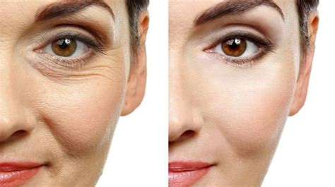 Best Botox in Delhi | Wrinkle Treatment in Delhi | DermaWorld