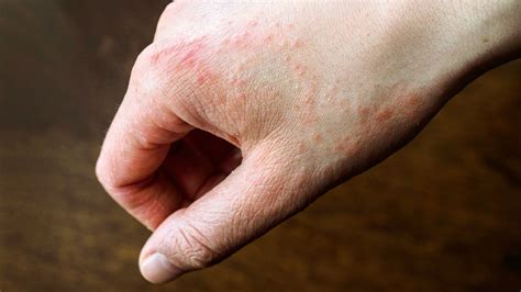 Viral Skin Rash Foot | Images and Photos finder