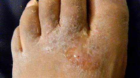 White Itchy Patch On Foot Online | emergencydentistry.com