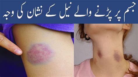 Neel Ke Nishan Ki Waja Aur Ilaj Blue Spot Marks On Skin Cause In Urdu ...