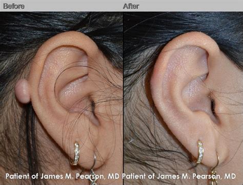 Keloid Removal - Dr. James Pearson Facial Plastic Surgery