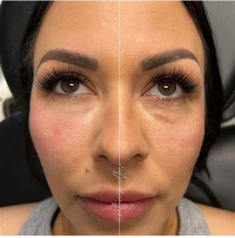 PRP vs. PRF and EZ Gel: Which is Better? - Aesthetic Assets