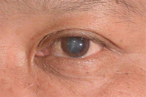 Cataracts - Symptoms, Causes & Treatment | Lions Eye Institute