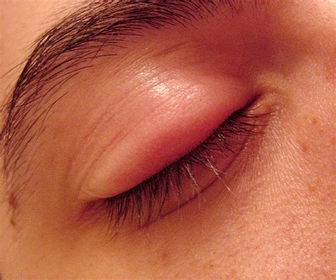 Underrated Ideas Of Tips About How To Get Rid Of A Swollen Eyelid ...