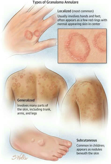 Granuloma Annulare | Dermatology nurse, Granuloma annulare, Dermatology