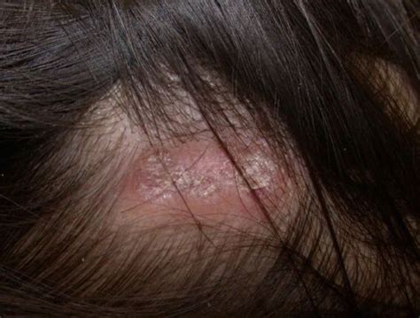 [Figure, Discoid Lupus, Scalp. Contributed by DermNetNZ] - StatPearls ...