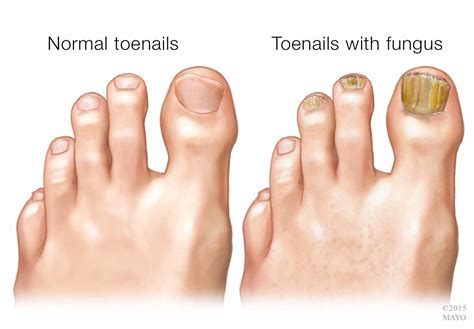 Fungal Toenail Treatment - Council Bluffs Foot & Ankle Care, PC ...