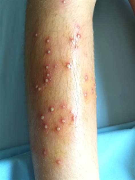 Our Guide to Folliculitis Treatment Melbourne: Causes, Symptoms ...