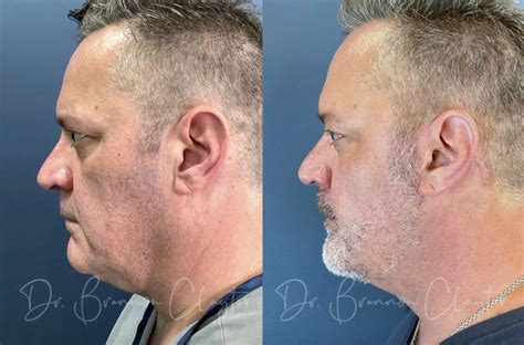 Men’s Facelifts: Get Masculine, Natural-Looking Results | Dr. Claytor