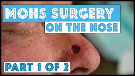 Mohs Surgery on the nose: Part 1 of 2, Taking Mohs Layers - YouTube