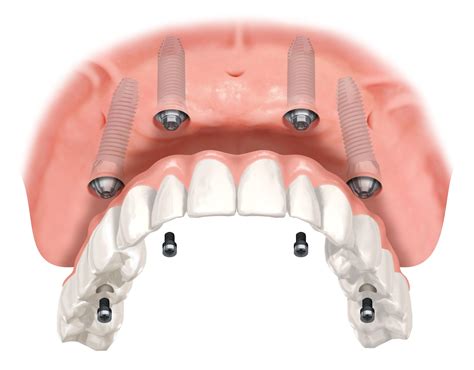 Cost of Full Mouth Dental Implants UK 2019