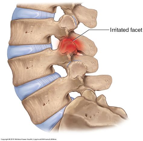 Facet Joint Sprain - Back in Action