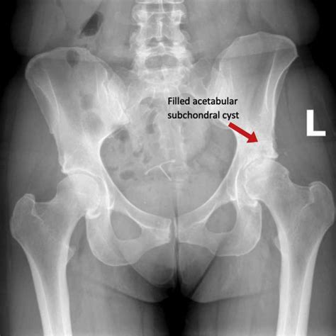 Hip Cysts | Acetabular Paralabral Cyst & Subchondral Cyst | FAI ...