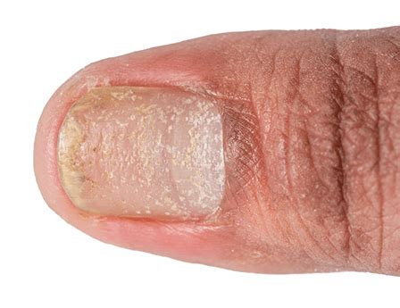 Nail Psoriasis: Symptoms, Causes, Prevention, and Treatment Options