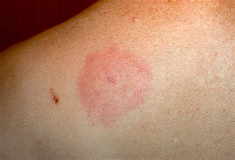 Lyme Disease Rash Pictures