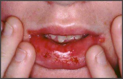 Shingles in mouth pictures | Shingles Expert